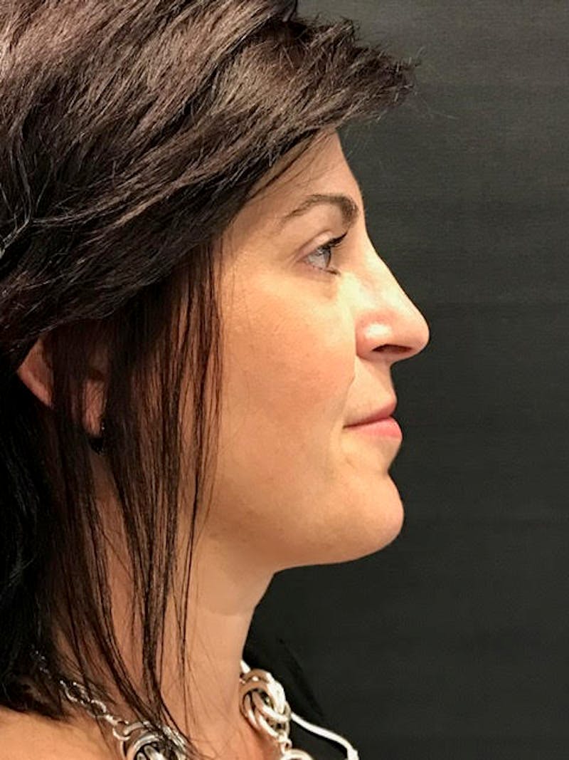 Fat Transfer Before & After Gallery - Patient 249743 - Image 5