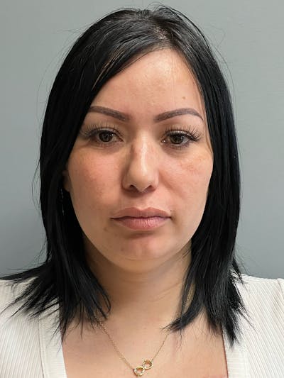 Neck Lift Before & After Gallery - Patient 925982 - Image 1