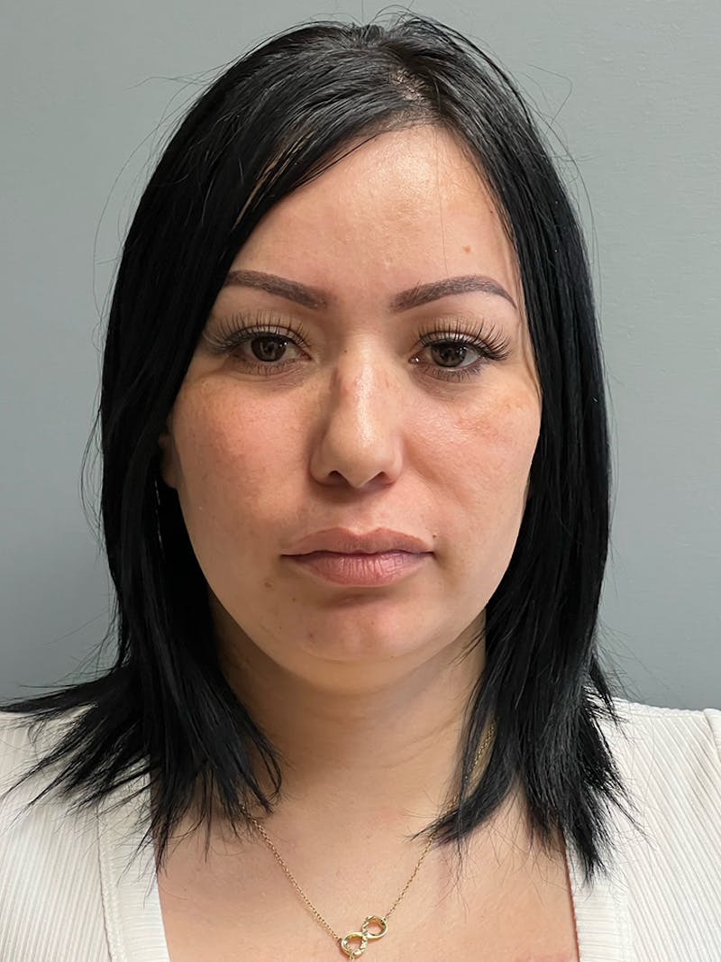Neck Lift Before & After Gallery - Patient 925982 - Image 1