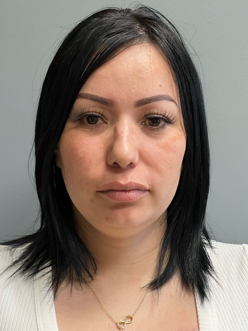 Deep Plane Neck Lift Before & After Gallery - Patient 296030 - Image 1