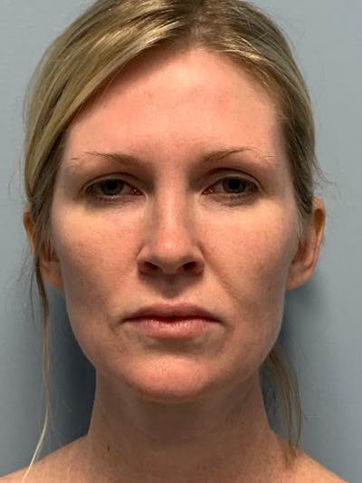SOTA Lift Before & After Gallery - Patient 913177 - Image 1
