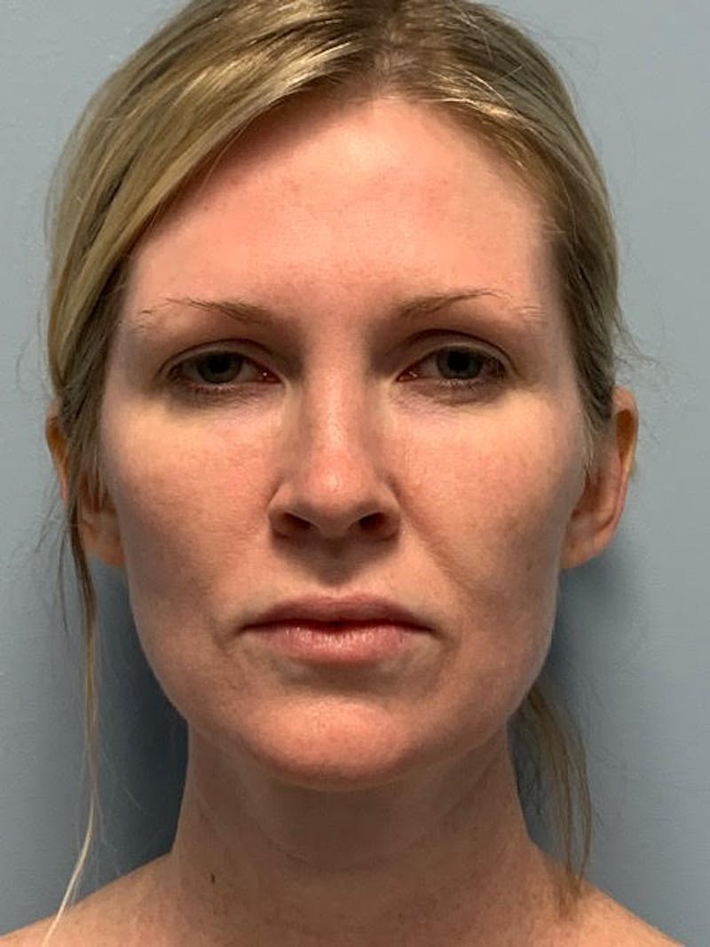 SOTA Lift Before & After Gallery - Patient 913177 - Image 1