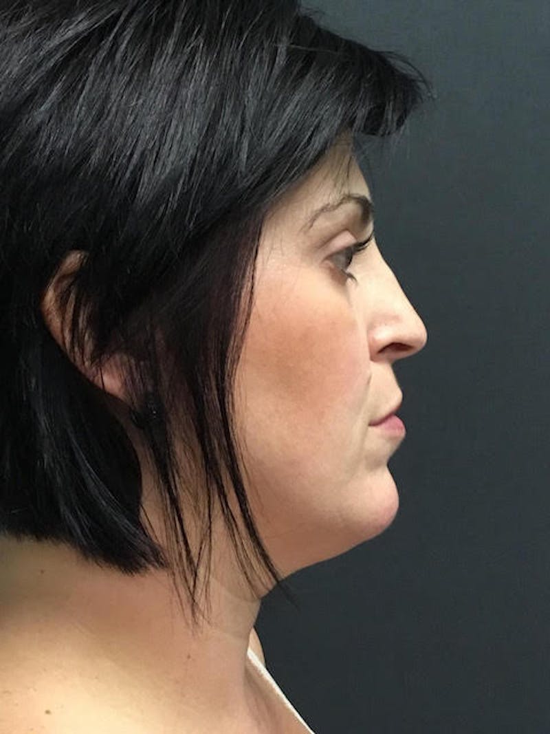 Fat Transfer Before & After Gallery - Patient 249743 - Image 6