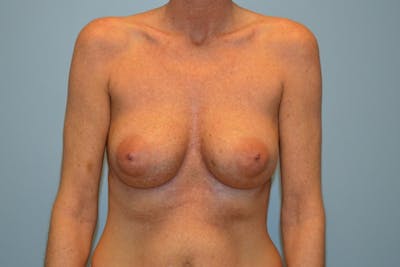 Corrective Breast Procedures Before & After Gallery - Patient 156661 - Image 1