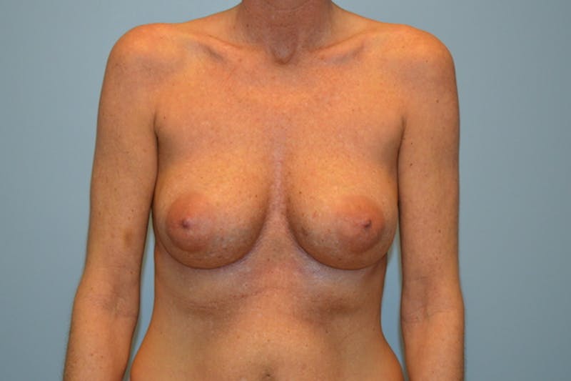 Corrective Breast Procedures Before & After Gallery - Patient 156661 - Image 1