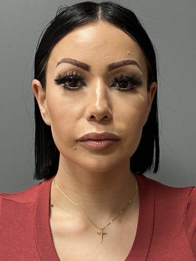 Deep Plane Neck Lift Before & After Gallery - Patient 296030 - Image 2
