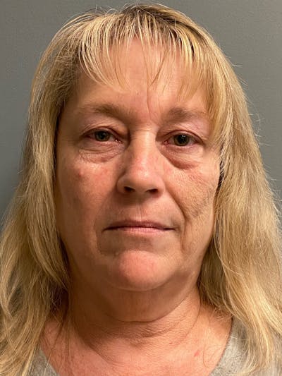 Deep Plane Facelift Before & After Gallery - Patient 395460 - Image 1