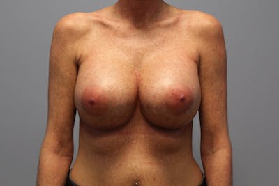 Corrective Breast Procedures Before & After Gallery - Patient 156661 - Image 2