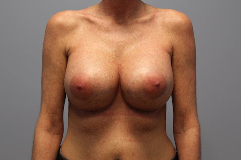 Corrective Breast Procedures Before & After Gallery - Patient 156661 - Image 2