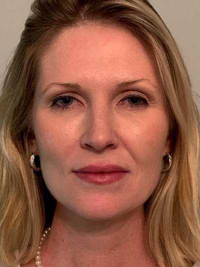 SOTA Lift Before & After Gallery - Patient 913177 - Image 2