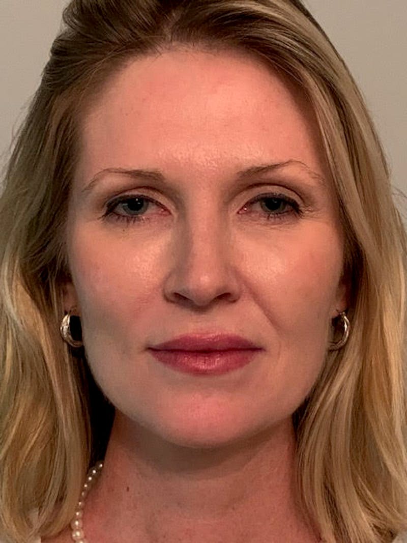 SOTA Lift Before & After Gallery - Patient 913177 - Image 2