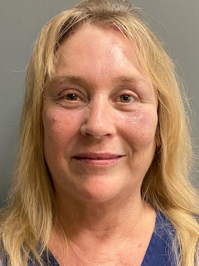 Deep Plane Facelift Before & After Gallery - Patient 395460 - Image 2