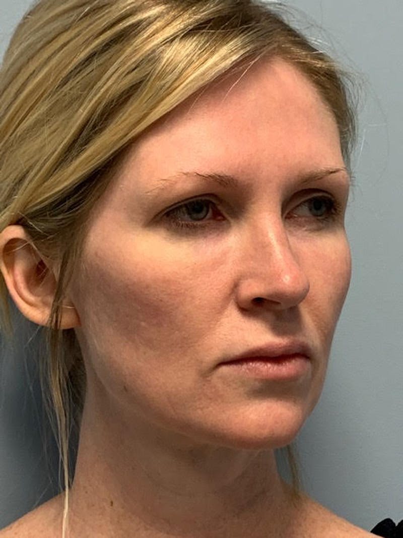 SOTA Lift Before & After Gallery - Patient 913177 - Image 3