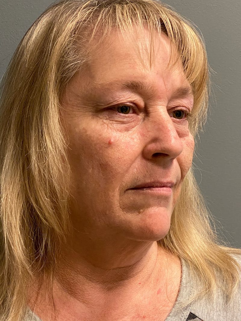 Deep Plane Facelift Before & After Gallery - Patient 395460 - Image 3