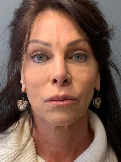 Fat Transfer Before & After Gallery - Patient 756089 - Image 2