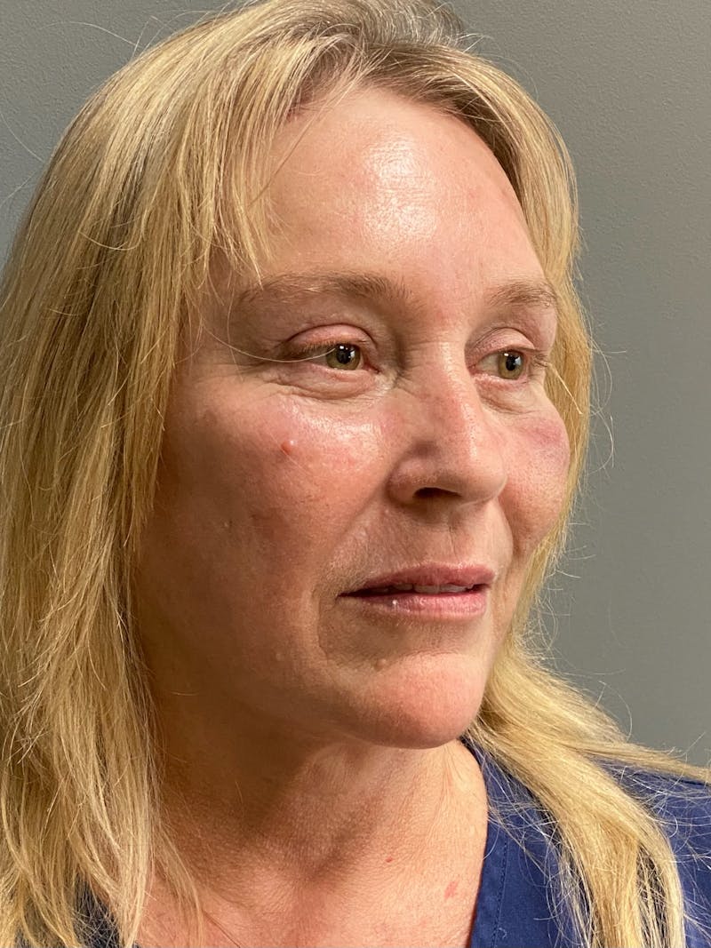 Deep Plane Facelift Before & After Gallery - Patient 395460 - Image 4