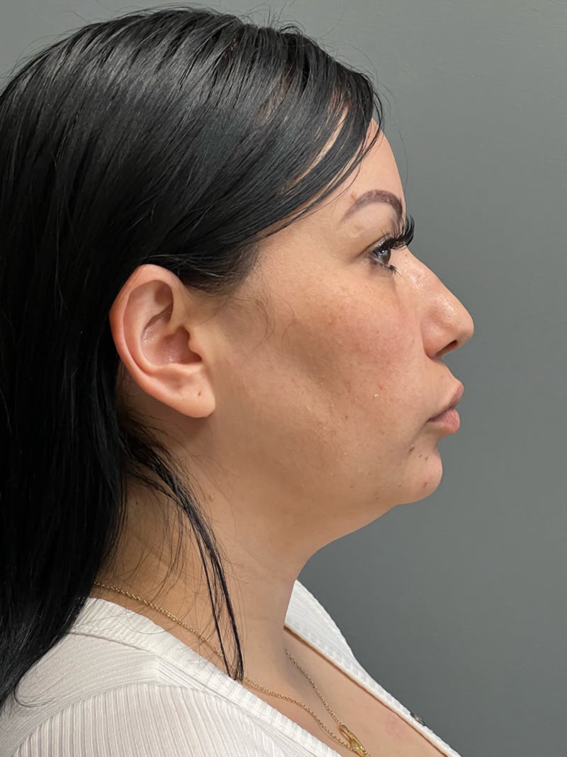 Neck Lift Before & After Gallery - Patient 925982 - Image 5