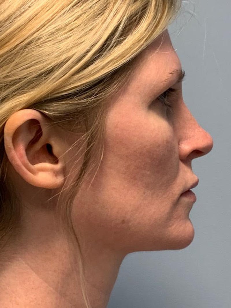 SOTA Lift Before & After Gallery - Patient 913177 - Image 5