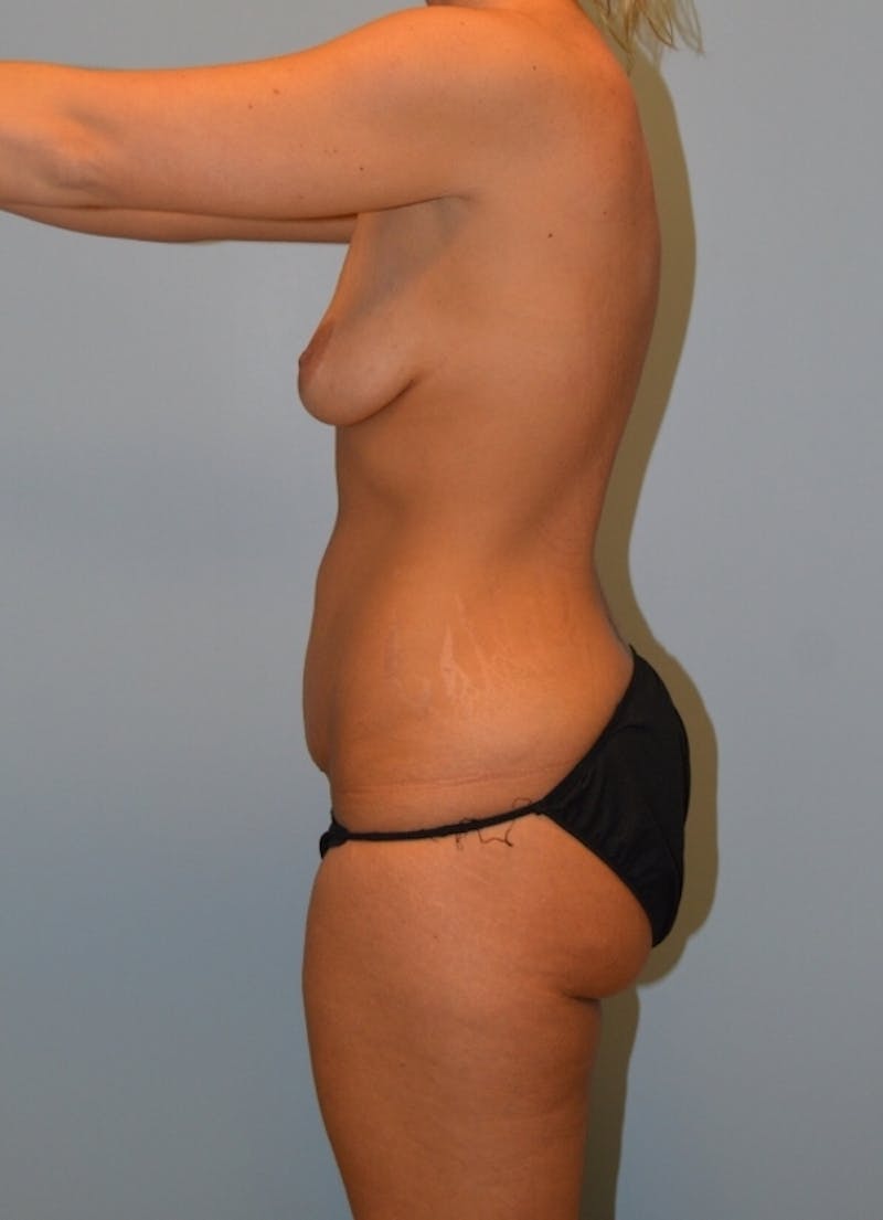 Tummy Tuck Before & After Gallery - Patient 114720 - Image 3