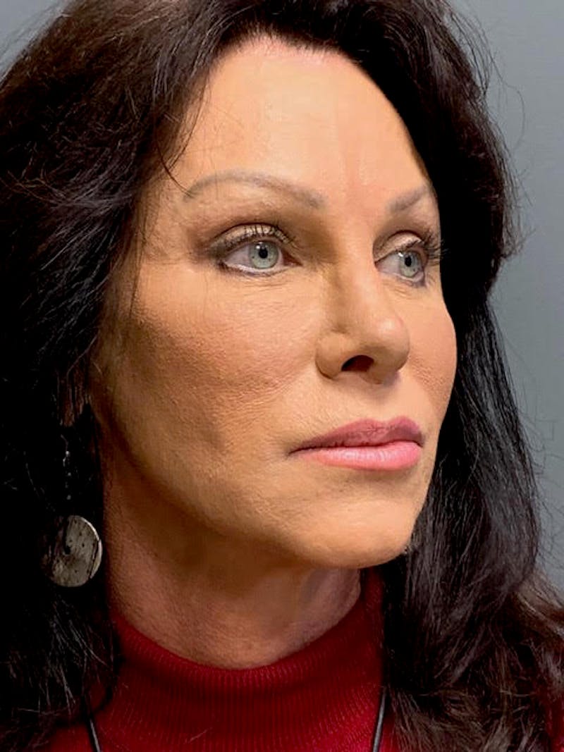 Fat Transfer Before & After Gallery - Patient 756089 - Image 3