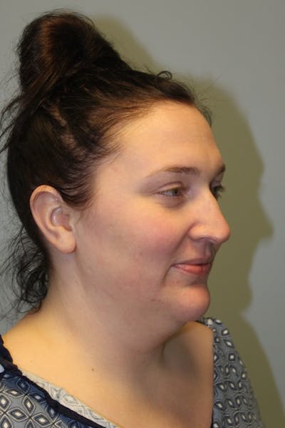 FaceTite (Non-Invasive Skin Tightening) Before & After Gallery - Patient 158798 - Image 1