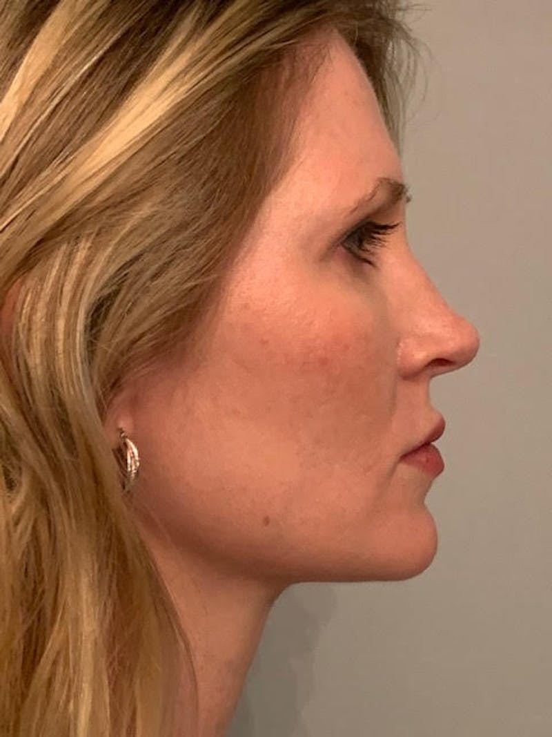 SOTA Lift Before & After Gallery - Patient 913177 - Image 6