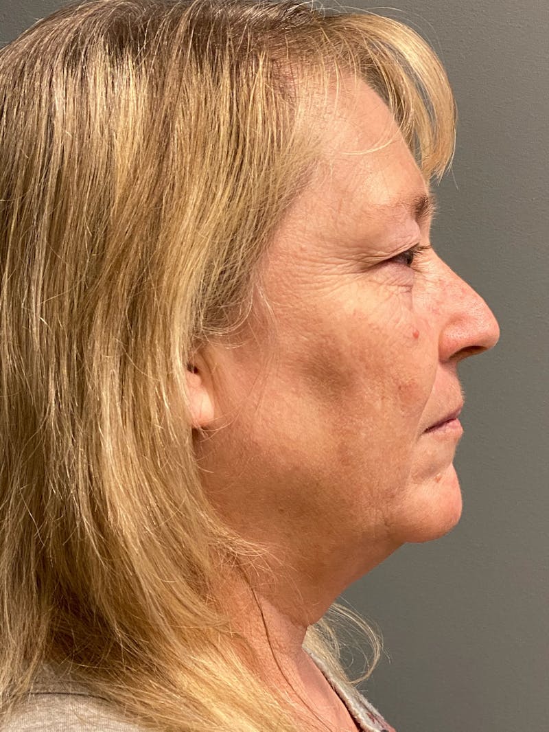 Deep Plane Facelift Before & After Gallery - Patient 395460 - Image 5
