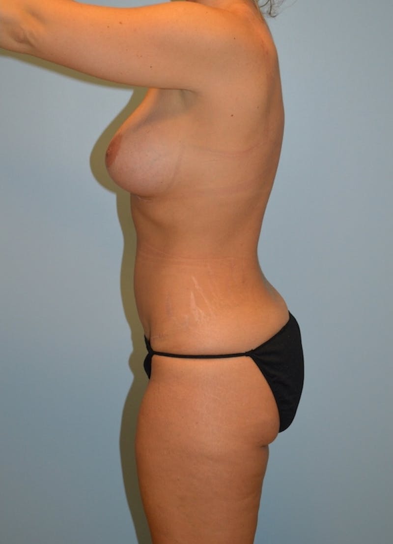 Tummy Tuck Before & After Gallery - Patient 114720 - Image 4