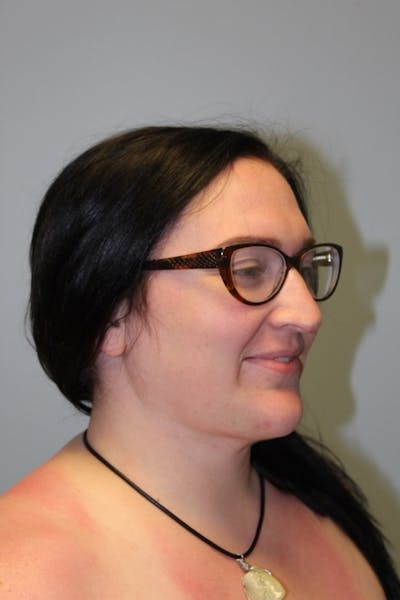 FaceTite (Non-Invasive Skin Tightening) Before & After Gallery - Patient 158798 - Image 2