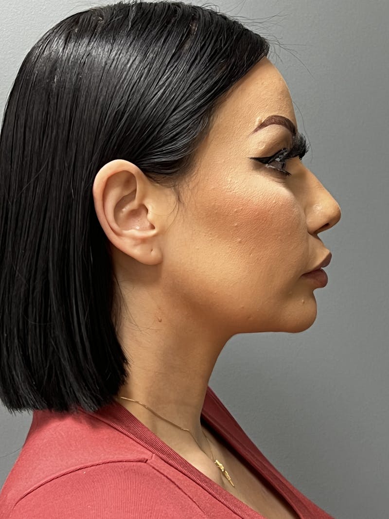 Deep Plane Neck Lift Before & After Gallery - Patient 296030 - Image 6