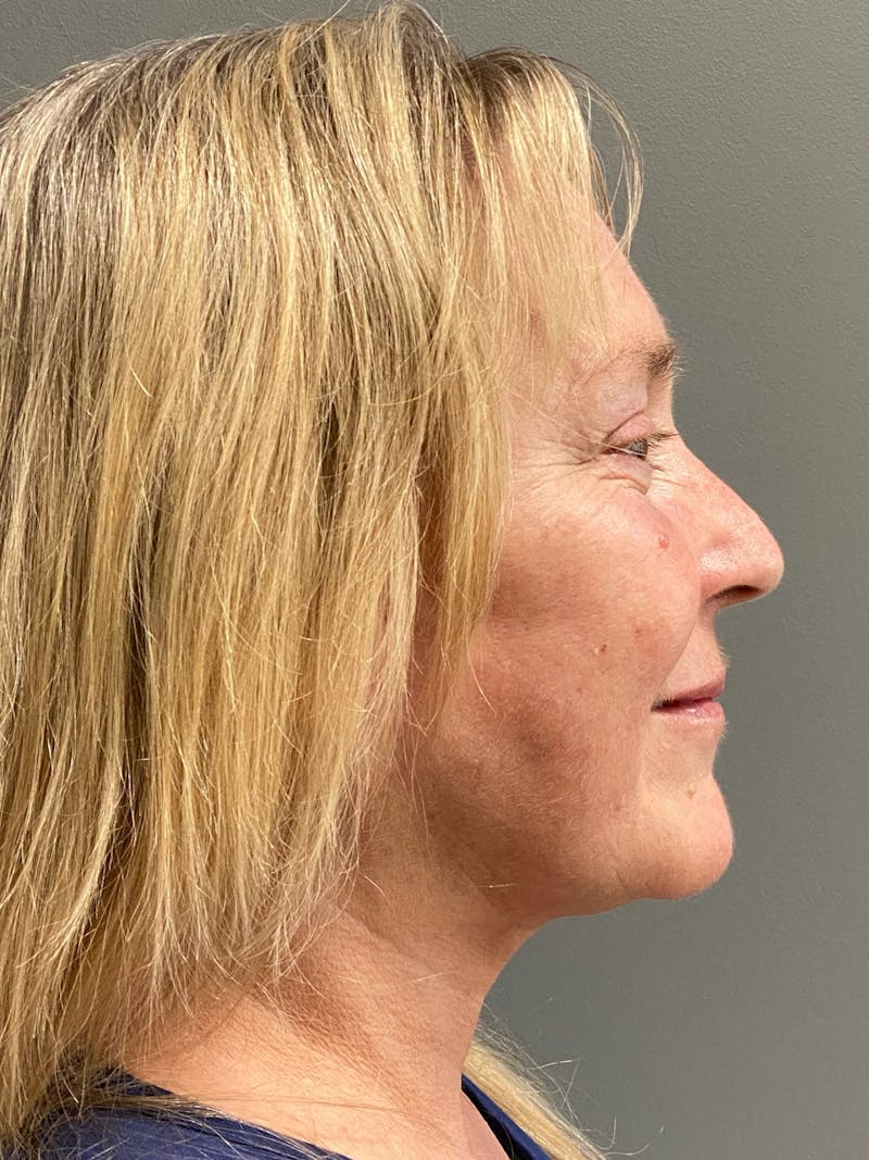 Deep Plane Facelift Before & After Gallery - Patient 395460 - Image 6