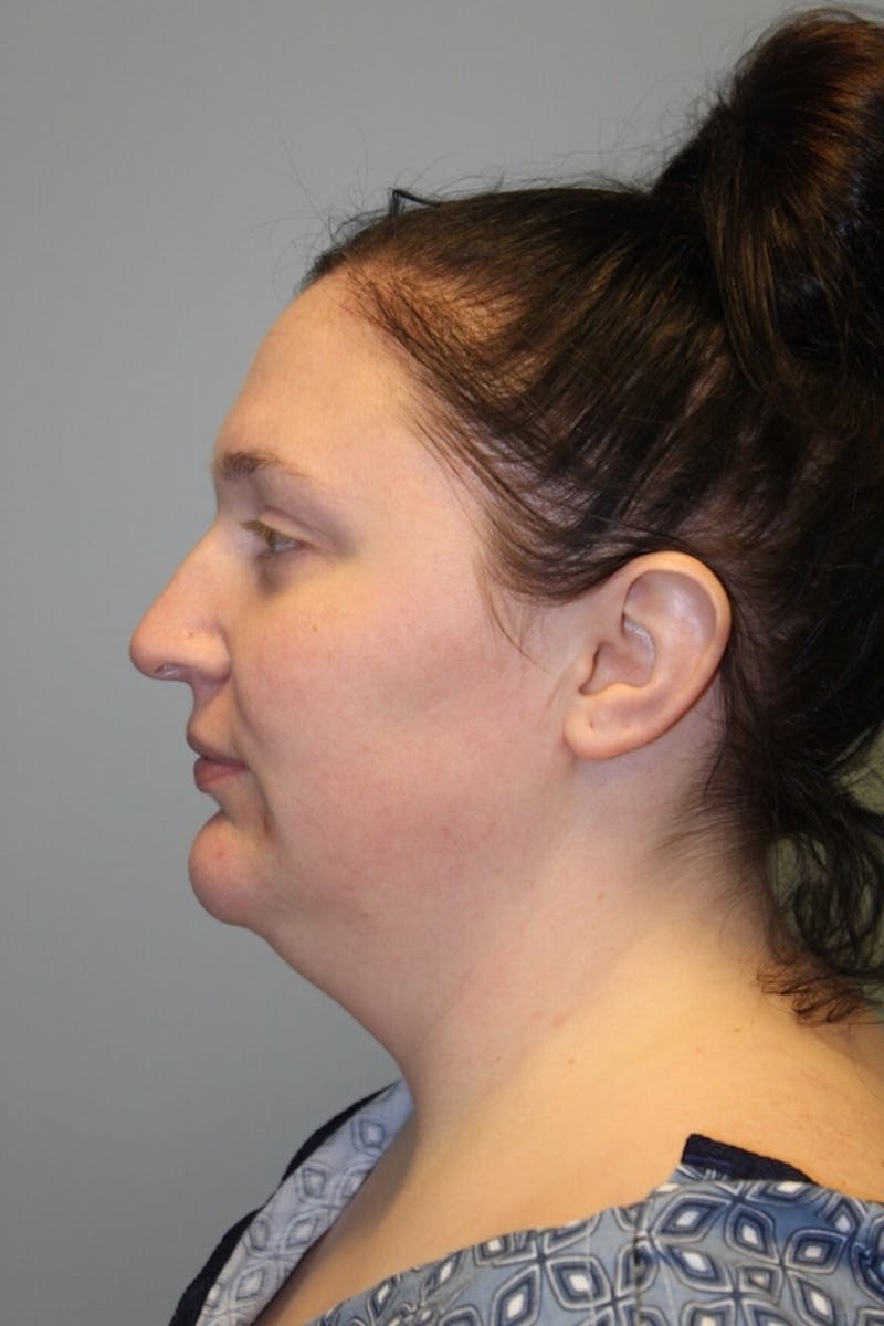 FaceTite (Non-Invasive Skin Tightening) Before & After Gallery - Patient 158798 - Image 3