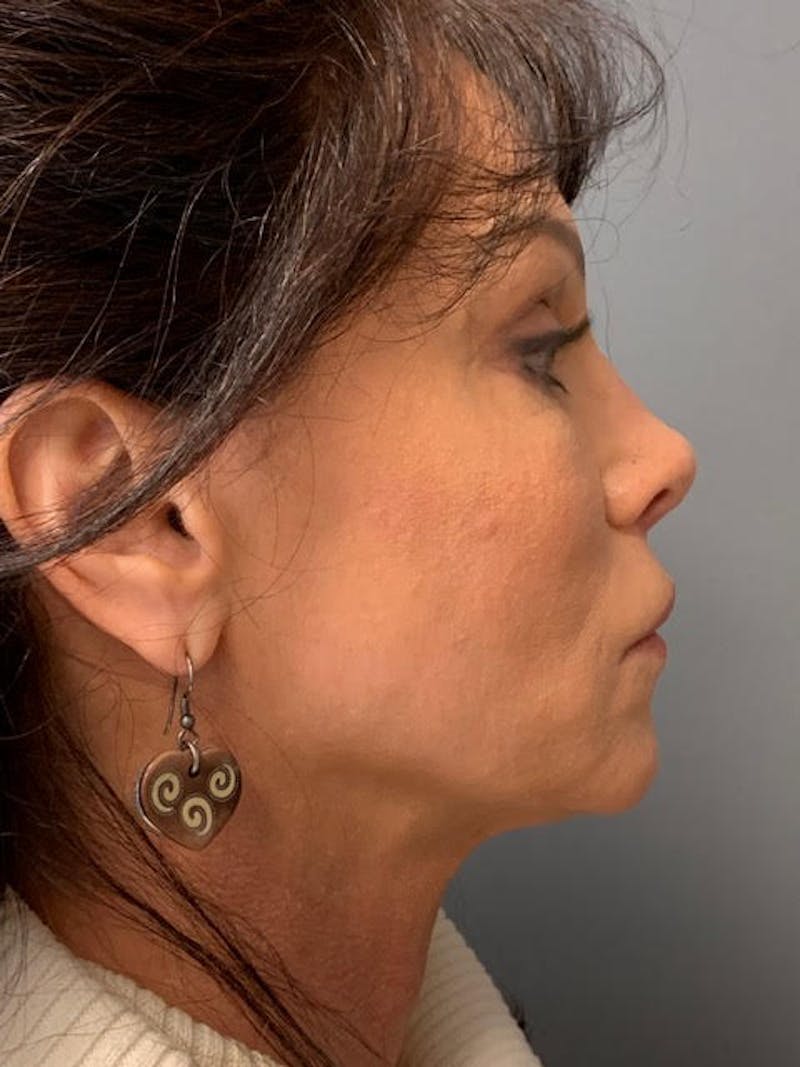 Fat Transfer Before & After Gallery - Patient 756089 - Image 6