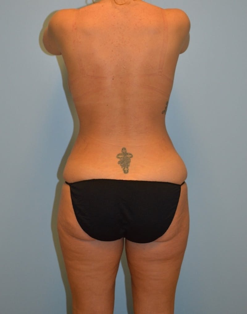 Tummy Tuck Before & After Gallery - Patient 114720 - Image 6