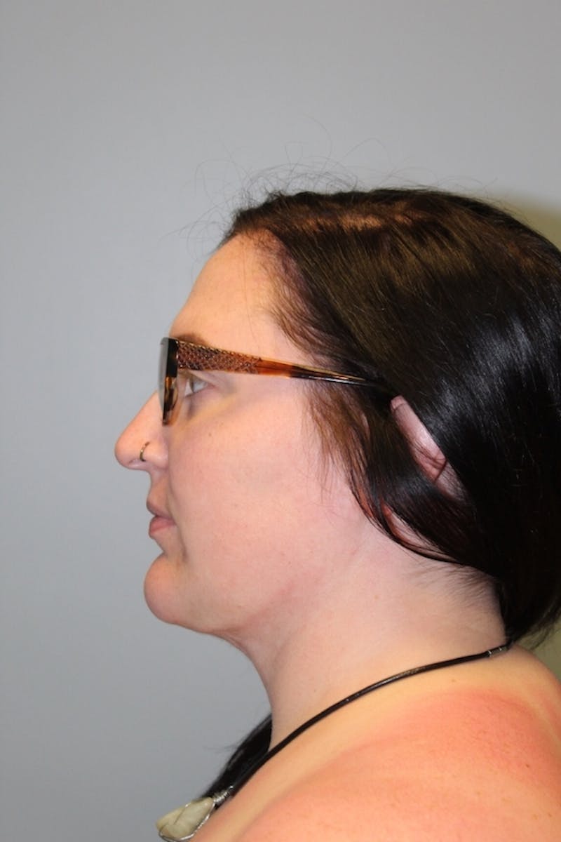 FaceTite (Non-Invasive Skin Tightening) Before & After Gallery - Patient 158798 - Image 4