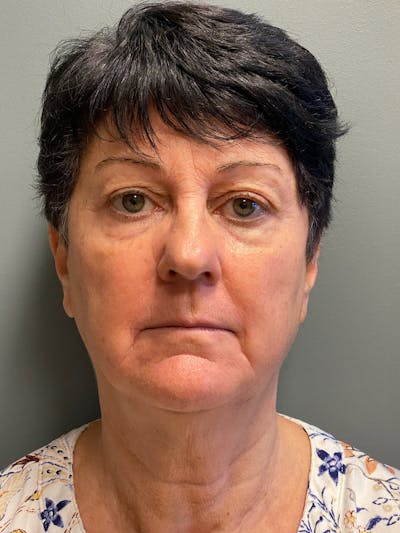 Deep Plane Facelift Before & After Gallery - Patient 717019 - Image 1