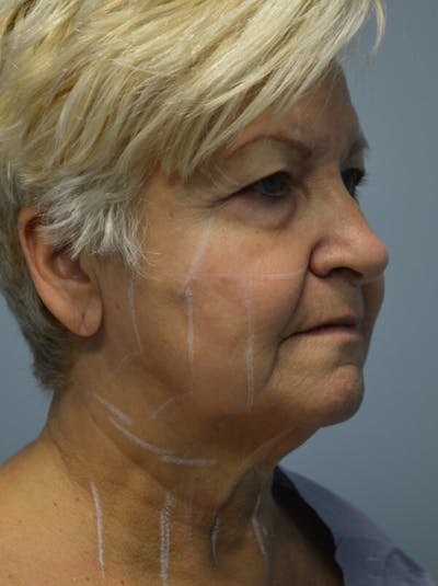 Ultherapy (Non-invasive Skin Tightening) Before & After Gallery - Patient 363767 - Image 1