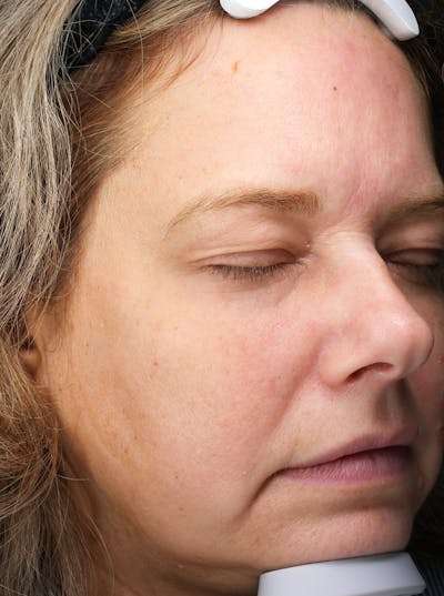 FaceTite (Non-Invasive Skin Tightening) Before & After Gallery - Patient 421618 - Image 1