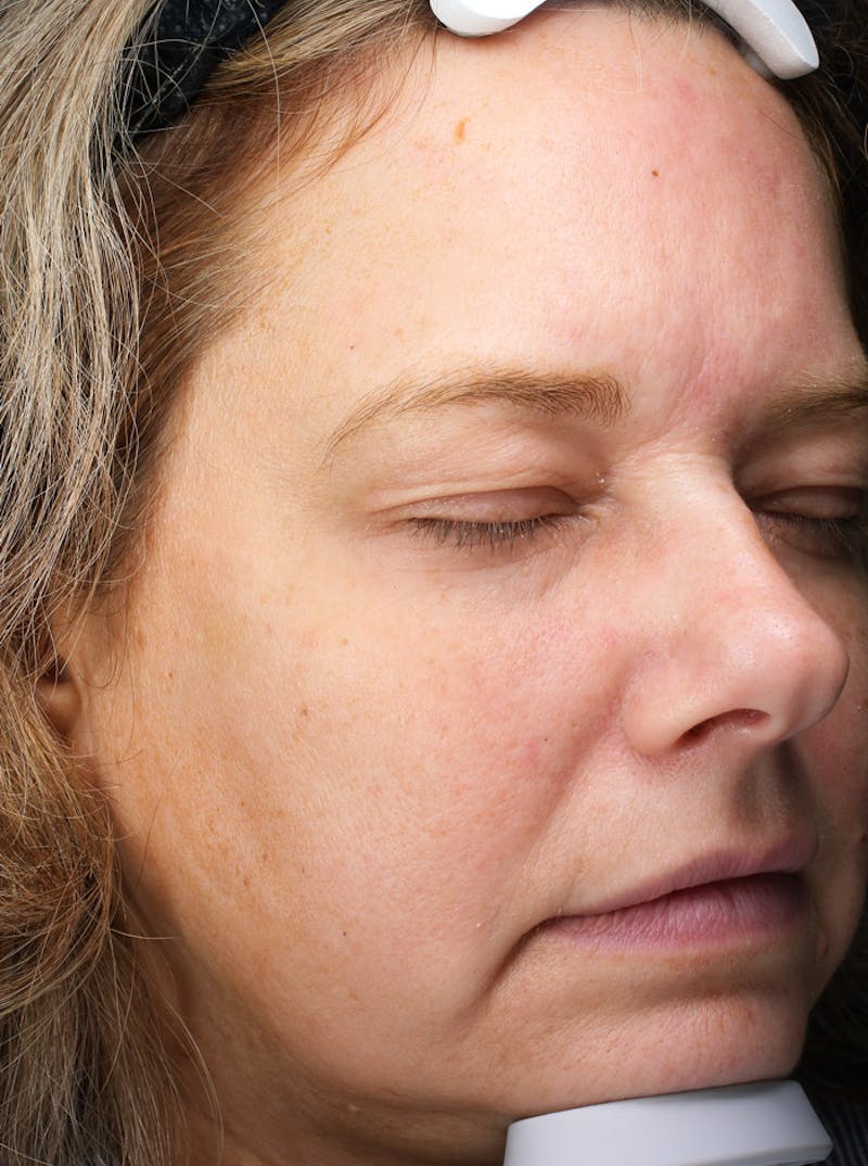 FaceTite (Non-Invasive Skin Tightening) Before & After Gallery - Patient 421618 - Image 1