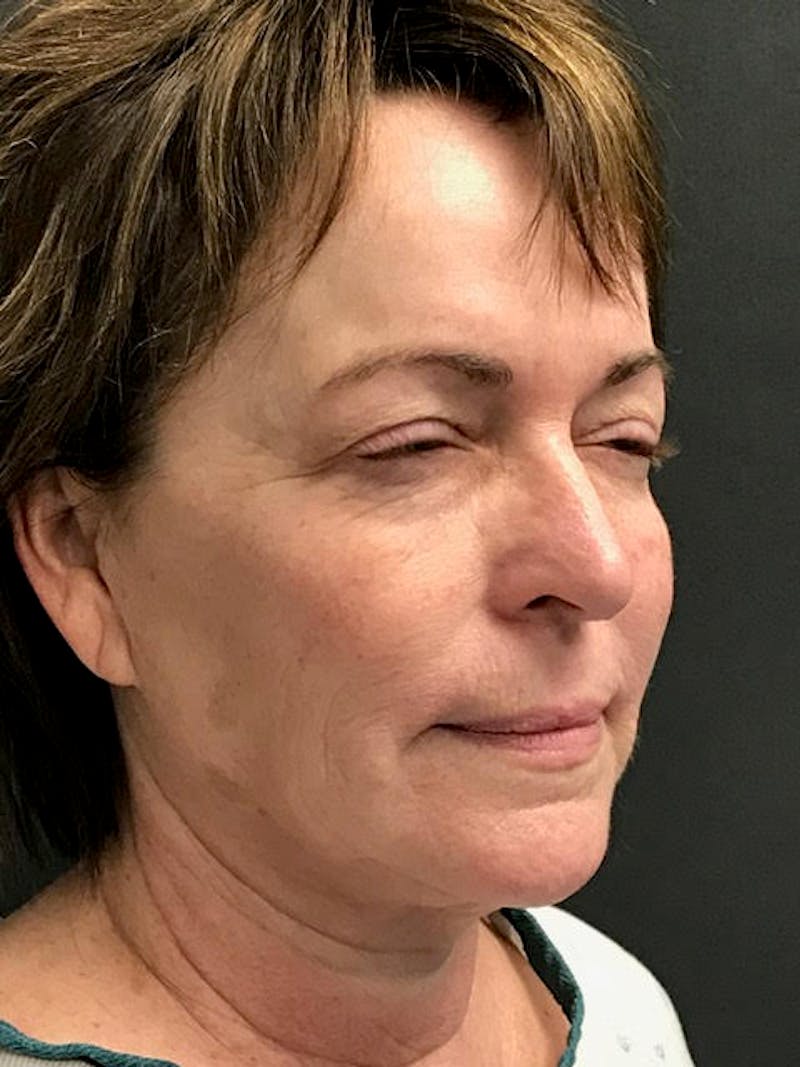 Neck Lift Before & After Gallery - Patient 211559 - Image 3