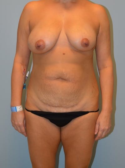Tummy Tuck Before & After Gallery - Patient 149740 - Image 1