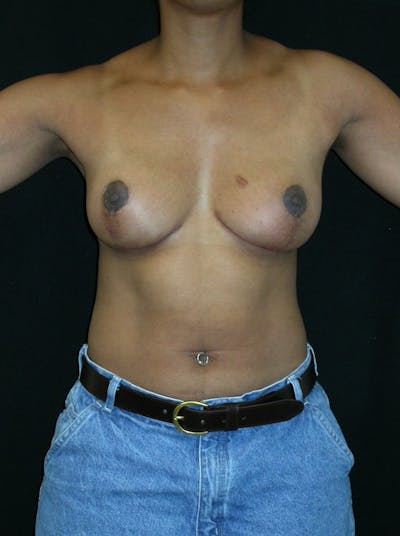 Breast Lift Before & After Gallery - Patient 200627 - Image 2