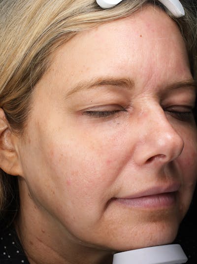 FaceTite (Non-Invasive Skin Tightening) Before & After Gallery - Patient 421618 - Image 2