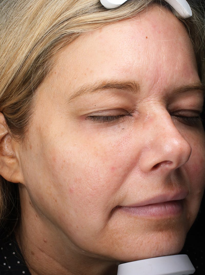 FaceTite (Non-Invasive Skin Tightening) Before & After Gallery - Patient 421618 - Image 2