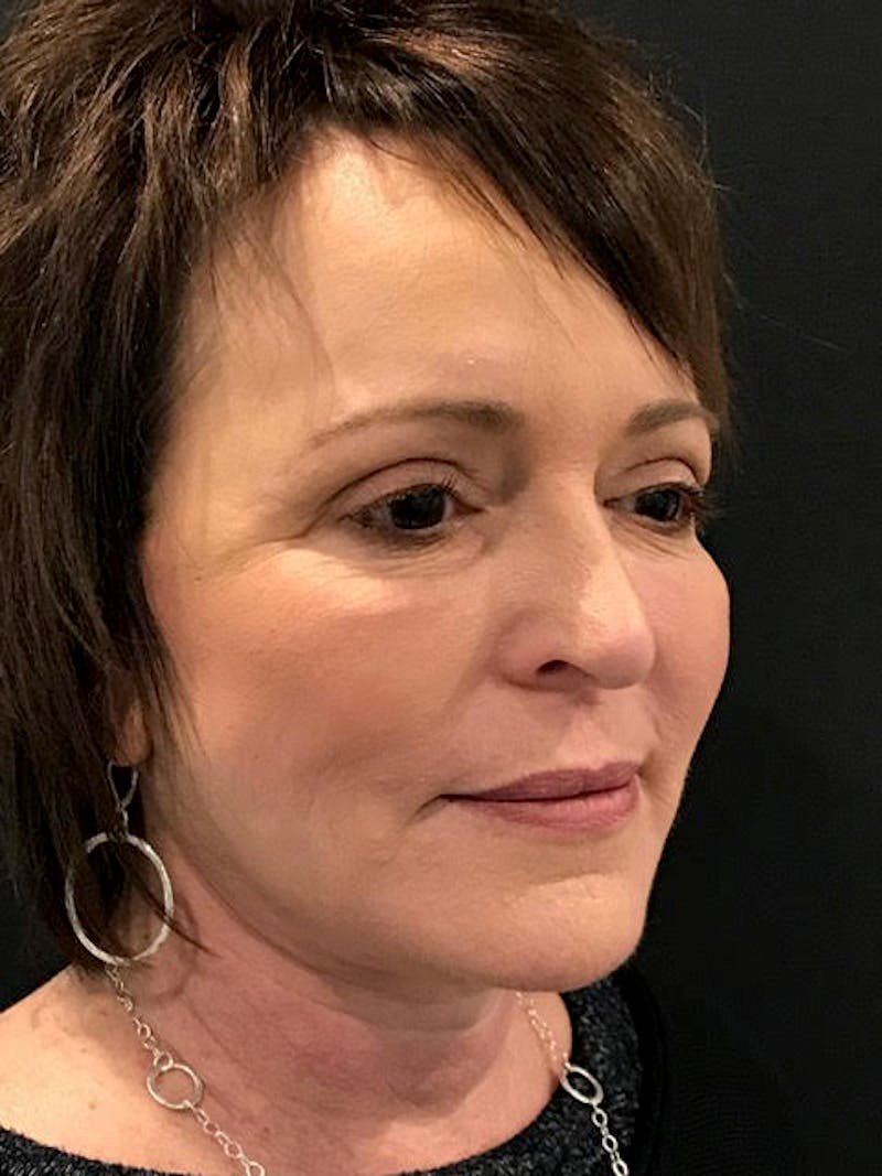 Neck Lift Before & After Gallery - Patient 211559 - Image 4