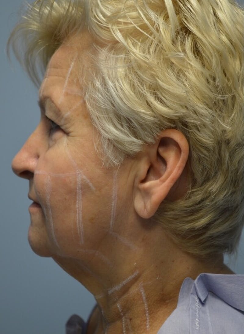 Ultherapy (Non-invasive Skin Tightening) Before & After Gallery - Patient 363767 - Image 3