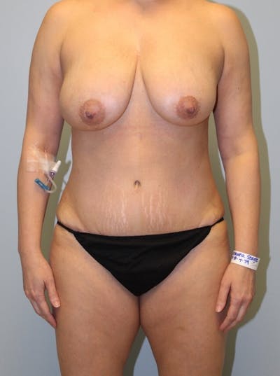 Tummy Tuck Before & After Gallery - Patient 149740 - Image 2