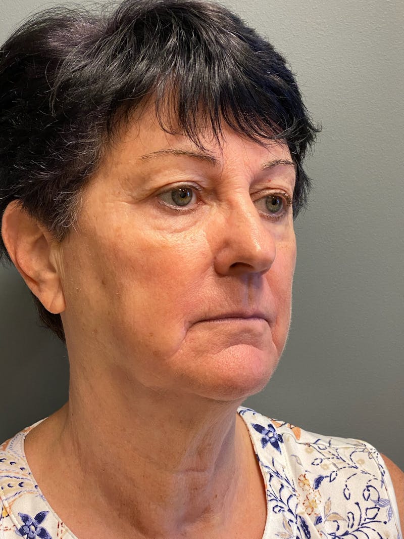 Deep Plane Facelift Before & After Gallery - Patient 717019 - Image 3
