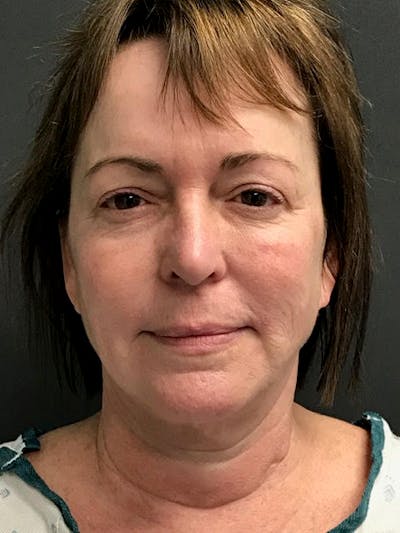 Facelift Before & After Gallery - Patient 115290 - Image 1