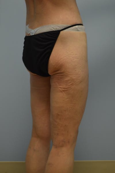 BodyTite (Scarless Skin Tightening) Before & After Gallery - Patient 207806 - Image 1